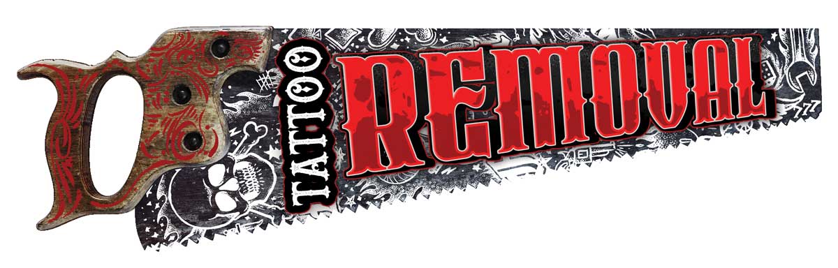 SS95009 - TATTOO REMOVAL